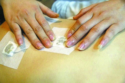 中醫(yī)院“三九貼”已開始預(yù)約 市民最好先檢查再貼敷