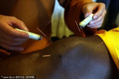 圖文-少林禪醫(yī)為皮特魯斯根治頑疾 做針灸需要勇氣