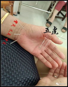 董氏針灸微課堂 十大處方之