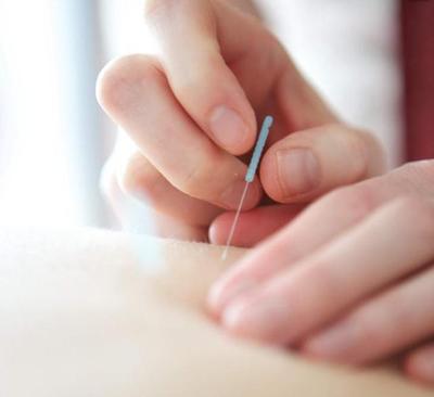 最新研究發(fā)現(xiàn):針灸可以促進(jìn)骨折愈合