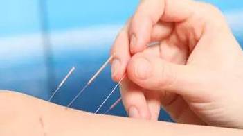 針灸 國之瑰寶，醫之精髓