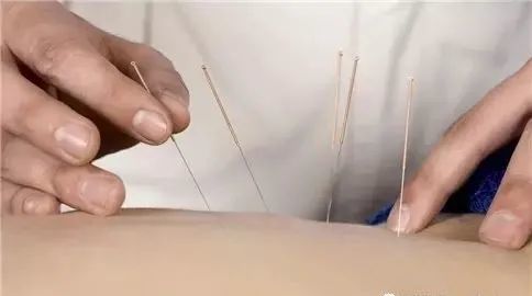 針灸減肥的三大常見(jiàn)誤區(qū)